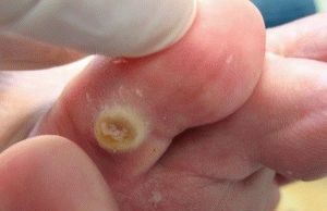 Натоптыши со стержнем – причины заболевания и особенности лечения