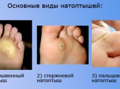 Натоптыши на ступнях: лечение, быстрое избавление
