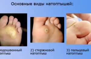 Натоптыши на ступнях: лечение, быстрое избавление