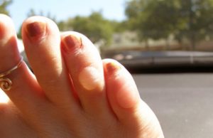 К какому врачу идти, для лечения мозоли?