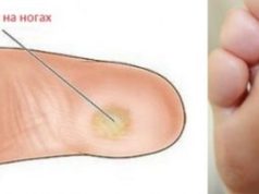 Как избавиться от натоптышей народными методами и в клинике