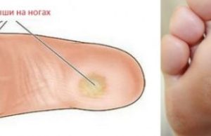 Как избавиться от натоптышей народными методами и в клинике