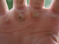 Сухие мозоли на руках: фото их типов и специфика лечения, советы, как убрать уплотнения на пальцах