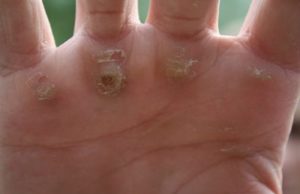 Сухие мозоли на руках: фото их типов и специфика лечения, советы, как убрать уплотнения на пальцах