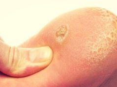 Натоптыши на ступнях – причины и быстрое лечение в домашних условиях