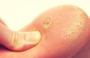 Натоптыши на ступнях – причины и быстрое лечение в домашних условиях