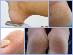 Натоптыши на пятках — как убрать (профессиональные методы, медикаментозные и народные средства)