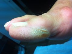 Натоптыши на пальцах ног (большом или других): что это такое, как избавиться в домашних условиях, чем вылечить, как убрать с помощью пластырей, мазей и фото недуга