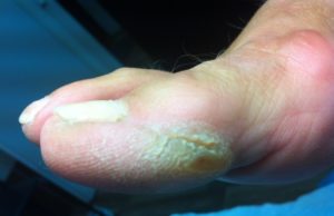 Натоптыши на пальцах ног (большом или других): что это такое, как избавиться в домашних условиях, чем вылечить, как убрать с помощью пластырей, мазей и фото недуга