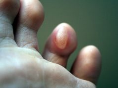 Мозоль на стопе (ступне): как её вылечить в домашних условиях