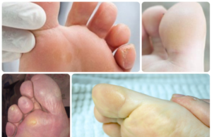 Натоптыши на пальцах ног — как избавиться (профессиональные методы удаления, медикаментозные и народные средства)