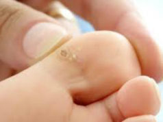 Натоптыши на пальцах ног — как избавиться, лечение