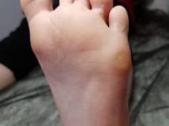 Как избавиться от натоптышей: ТОП методов лечения