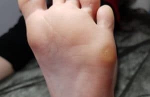 Как избавиться от натоптышей: ТОП методов лечения