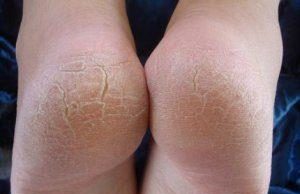 Натоптыши на пятках: как избавиться, лечение в домашних условиях