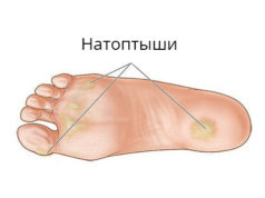 Как легко избавиться от натоптышей и грубой кожи