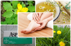 Народные средства от натоптышей и сухих мозолей — рецепты компрессов, мазей, ванночек