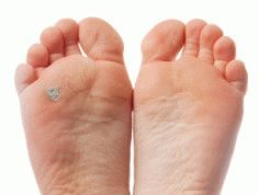 Что делать, если загноилась мозоль на ноге: советы и профилактика