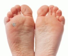 Что делать, если загноилась мозоль на ноге: советы и профилактика