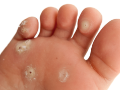 Лечение шипицы на ноге: фото, как вывести