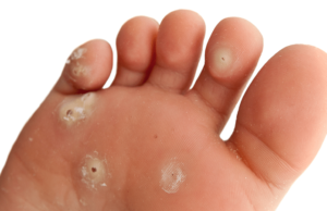 Лечение шипицы на ноге: фото, как вывести