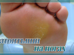 Натоптыши на ступнях на подошве со стержнем: лечение, фото