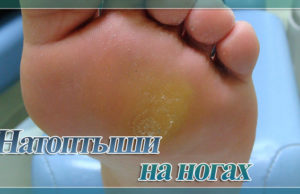 Натоптыши на ступнях на подошве со стержнем: лечение, фото