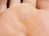 Подошвенная мозоль: фото, причины появления и лечение