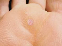 Подошвенная мозоль: фото, причины появления и лечение