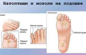Мозоль на пальце ноги: стержневая, сухая, костная