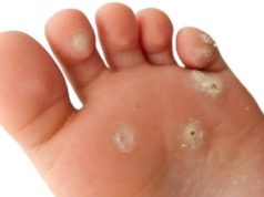 Какое лучше купить средство от натоптышей на ногах в аптеке: обзор действенных препаратов