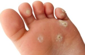 Какое лучше купить средство от натоптышей на ногах в аптеке: обзор действенных препаратов