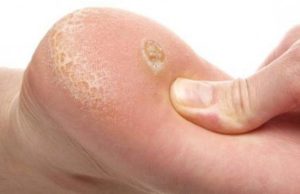 Средство от натоптышей: описание и отзывы