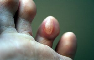 Сильно болит натоптыш на стопе что делать