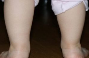 Мозоль на ноге у ребенка — виды, причины, методы лечения и профилактики