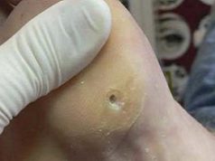 Стержневая мозоль: фото, причины, методы лечения у детей и взрослых