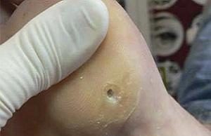Стержневая мозоль: фото, причины, методы лечения у детей и взрослых