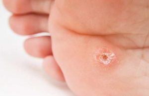 Как убрать натоптыши