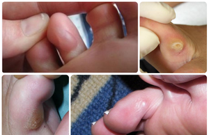 Болезненные мозоли между пальцами ног: особенности, причины появления и способы лечения