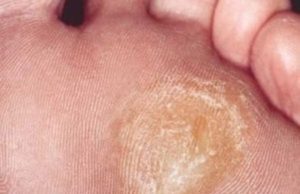 Народные средства от натоптышей: способы лечения в домашних условиях, фото