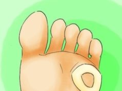 Сухие мозоли или натоптыши как избежать и лечить