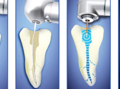 Процедура чистки зубных каналов