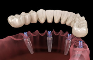 Современные методы имплантации зубов