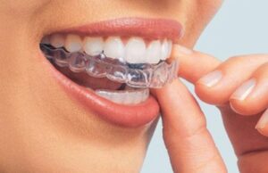 Лечение зубов элайнерами