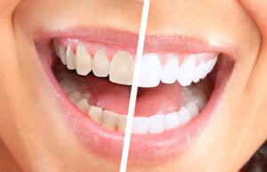 Стоит ли отбеливать зубы