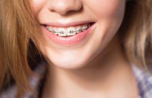 Преимущества металлических брекетов