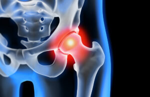Особенности лечения артроза тазобедренного сустава