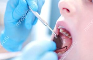 Как не пропустить симптомы начального кариеса и реально ли обнаружить патологию в домашних условиях: разбираемся вместе с врачами