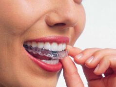 Как выбрать элайнер: обзор брендов