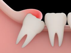 Особенности решение проблемы перикоронита в стоматологической клинике